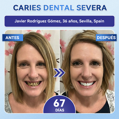 𝐆𝐥𝐢𝐦𝐦𝐞𝐫𝐥𝐲®😁🦷𝐓𝐢𝐝𝐞𝐠𝐥𝐮𝐬𝐢𝐛 𝐃𝐢𝐞𝐧𝐭𝐞𝐬 𝐘 𝐄𝐧𝐜í𝐚𝐬 𝐑𝐞𝐩𝐚𝐫𝐚𝐫 𝐌𝐢𝐜𝐫𝐨𝐧𝐞𝐞𝐝𝐥𝐞 𝐏𝐚𝐫𝐜𝐡𝐞 |𝑇𝑖𝑟𝑎𝑠 𝑑𝑒𝑛𝑡𝑎𝑙𝑒𝑠 𝑐𝑜𝑛 𝑡𝑒𝑐𝑛𝑜𝑙𝑜𝑔í𝑎 𝑎𝑣𝑎𝑛𝑧𝑎𝑑𝑎 𝑑𝑒 𝑎𝑐𝑡𝑖𝑣𝑎𝑐𝑖ó𝑛 𝑑𝑒 𝑐é𝑙𝑢𝑙𝑎𝑠 𝑚𝑎𝑑𝑟𝑒
