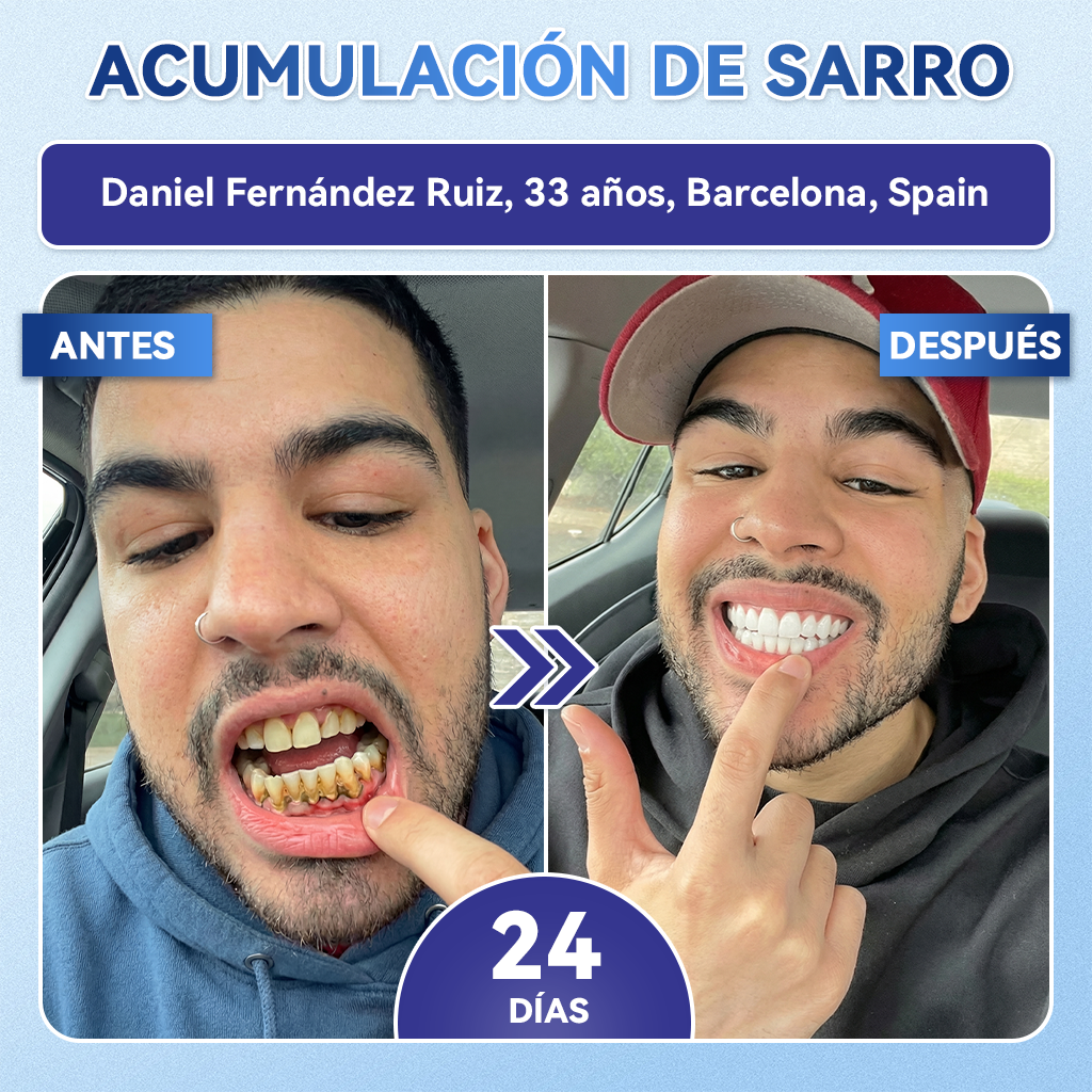 𝐆𝐥𝐢𝐦𝐦𝐞𝐫𝐥𝐲®😁🦷𝐓𝐢𝐝𝐞𝐠𝐥𝐮𝐬𝐢𝐛 𝐃𝐢𝐞𝐧𝐭𝐞𝐬 𝐘 𝐄𝐧𝐜í𝐚𝐬 𝐑𝐞𝐩𝐚𝐫𝐚𝐫 𝐌𝐢𝐜𝐫𝐨𝐧𝐞𝐞𝐝𝐥𝐞 𝐏𝐚𝐫𝐜𝐡𝐞 |𝑇𝑖𝑟𝑎𝑠 𝑑𝑒𝑛𝑡𝑎𝑙𝑒𝑠 𝑐𝑜𝑛 𝑡𝑒𝑐𝑛𝑜𝑙𝑜𝑔í𝑎 𝑎𝑣𝑎𝑛𝑧𝑎𝑑𝑎 𝑑𝑒 𝑎𝑐𝑡𝑖𝑣𝑎𝑐𝑖ó𝑛 𝑑𝑒 𝑐é𝑙𝑢𝑙𝑎𝑠 𝑚𝑎𝑑𝑟𝑒